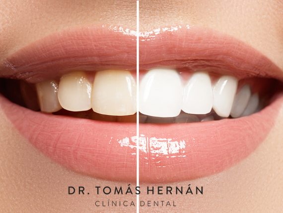 blanqueamiento dental blanqueamiento dental