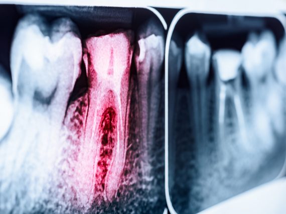 endodoncia endodoncia
